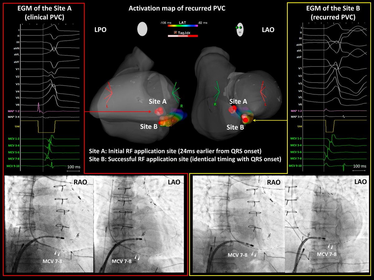 Heart Rhythm Case Reports (@hrs_casereports) on Twitter photo Over-the-Wire Microelectrode Catheter in the Middle Cardiac Vein for Treating Premature Ventricular Contractions from the Posterior-Superior Process of the Left Ventricle
<a href="/MasatoOkada1105/">Masato Okada</a>
heartrhythmcasereports.com/article/S2214-… Over-the-Wire Microelectrode Catheter in the Middle Cardiac Vein for Treating Premature Ventricular Contractions from the Posterior-Superior Process of the Left Ventricle
<a href="/MasatoOkada1105/">Masato Okada</a>
heartrhythmcasereports.com/article/S2214-…