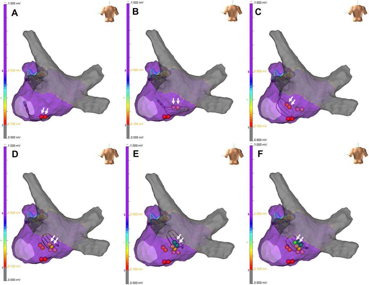 Pulsed-Field Ablation for Non-Pulmonary Vein Foci of Immediate Recurrence of Atrial Fibrillation Originating from the Left Arial Inferior Wall Directly Adjacent to the Esophagus 
heartrhythmcasereports.com/article/S2214-…