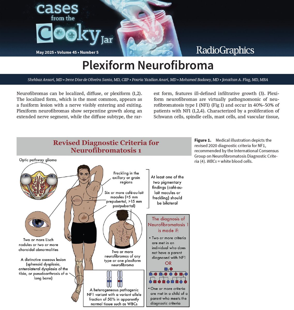 Irene Dixe de Oliveira Santo, MD, CIIP (@dixeirene) on Twitter photo Check out our new article on NF1 and plexiform neurofibromas! Grateful to be part of this team! <a href="/RadioGraphics/">RadioGraphics</a> <a href="/YaleRadRes/">Yale Radiology Residents</a> Check out our new article on NF1 and plexiform neurofibromas! Grateful to be part of this team! <a href="/RadioGraphics/">RadioGraphics</a> <a href="/YaleRadRes/">Yale Radiology Residents</a>