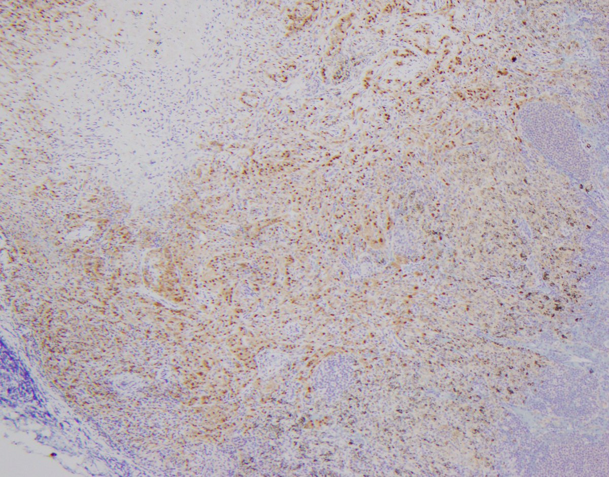 Tumour in lung. Odd looking tumour present in vessels and lymph nodes. The IHC is definitive but stains a bit weaker in the tumour in vessels than in the lymph node.

But what is the IHC marker and therefore what is the tumour?