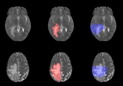 Radiology: Artificial Intelligence (@radiology_ai) on Twitter photo BraTS-Africa dataset to improve the generalizability of #ML methods in #BrainTumor imaging doi.org/10.1148/ryai.2… <a href="/AMAdewole/">Maruf Adewole</a> <a href="/CmulNigeria/">CMULNigeria</a> <a href="/LUTHofficial/">LUTH</a> #dataset #cancer #AI BraTS-Africa dataset to improve the generalizability of #ML methods in #BrainTumor imaging doi.org/10.1148/ryai.2… <a href="/AMAdewole/">Maruf Adewole</a> <a href="/CmulNigeria/">CMULNigeria</a> <a href="/LUTHofficial/">LUTH</a> #dataset #cancer #AI