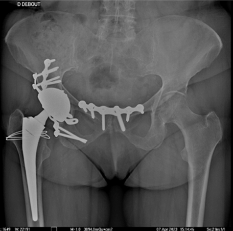 This study showed that the use of dual mobility in concomitant THA with ORIF for acetabular fracture in patients >60yo achieved a low dislocation rate with favorable clinical and radiological outcomes and a low complication rate.

arthroplastyjournal.org/article/S0883-…