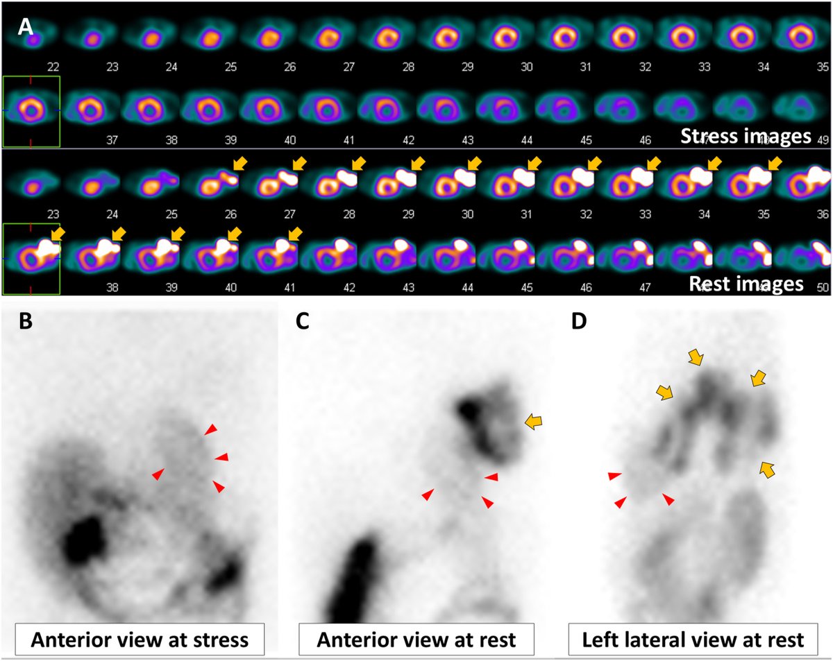 Journal of Nuclear Cardiology (@jncjournal) on Twitter photo MPI interpretation should include planar images to better recognize the distribution of extracardiac tracer activity <a href="/juntendo_univ/">Juntendo University</a> #cvnuc
Read now👉bit.ly/43Zzmz3 MPI interpretation should include planar images to better recognize the distribution of extracardiac tracer activity <a href="/juntendo_univ/">Juntendo University</a> #cvnuc
Read now👉bit.ly/43Zzmz3