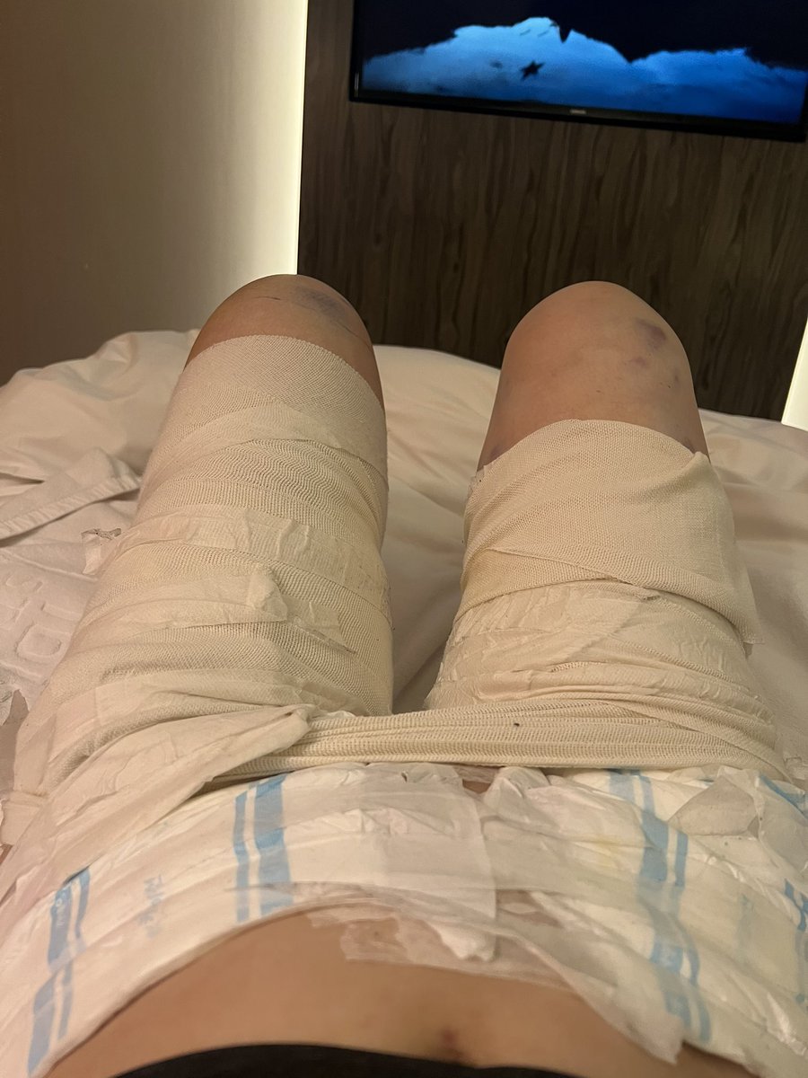 エッジラインクリニックさんで太ももとお尻の脂肪吸引してもらいました✨✨
純脂肪2400cc大満足💗
ただ覚悟はしていたが痛いです。笑笑
dt１日目
☑️おしっこがしにくい
☑️寝転びにくい
☑️歩くのが赤ちゃん並みに遅い
☑️軽く熱がある
☑️喉が渇く
☑️もちろん痛い
☑️便座とは戦い
<a href="/edgeline_jpkr/">エッジラインクリニック</a>