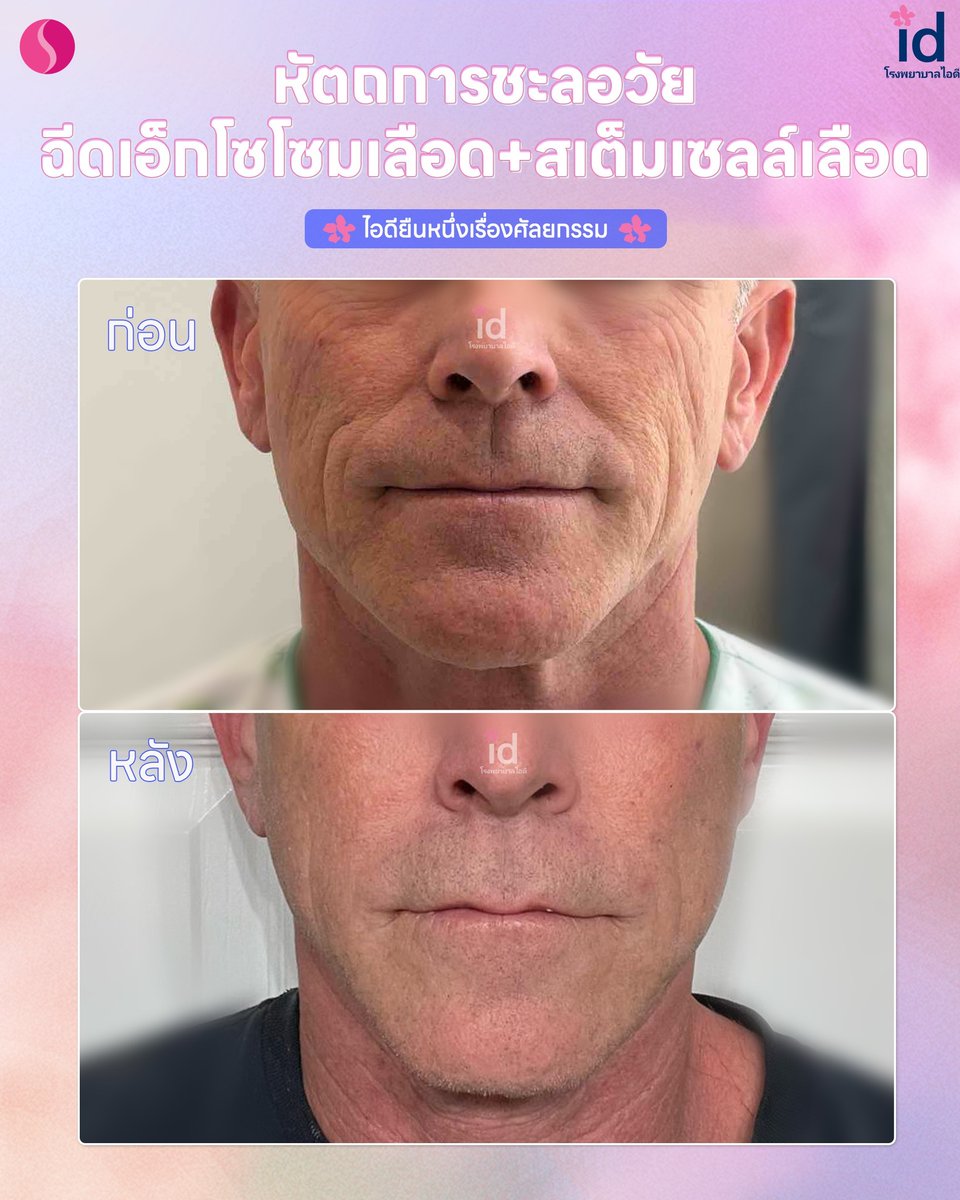 stmstyle_'s tweet photo. อยากผิวเต่งตึงสดใส มาดู รีวิวหัถการชะลอวัย ฉีด #IDBloodStemExosome พร้อม #IDBloodStemInjection ที่ใบหน้า จากลูกค้าจริงของไอดีกันค่าาา✨ 

ปรึกษาฟรี! Line Official: https://t.co/z0nCYcwy5u 

#ศัลยกรรม #รีวิวศัลยกรรม #หัตถการ #ผิวสวยชะลอวัย #โรงพยาบาลไอดี https://t.co/lfUW4fzkhV