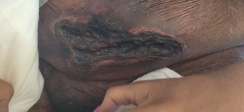 Non-ICU rounds Monday afternoon: 
Abdominal Calciphylaxis, 65 y/o woman ESRD on thrice weekly HD x years, PTH 150-300 pg/ml, receiving Na-Thiosulfate 3x/week.  Anything (else) to do?