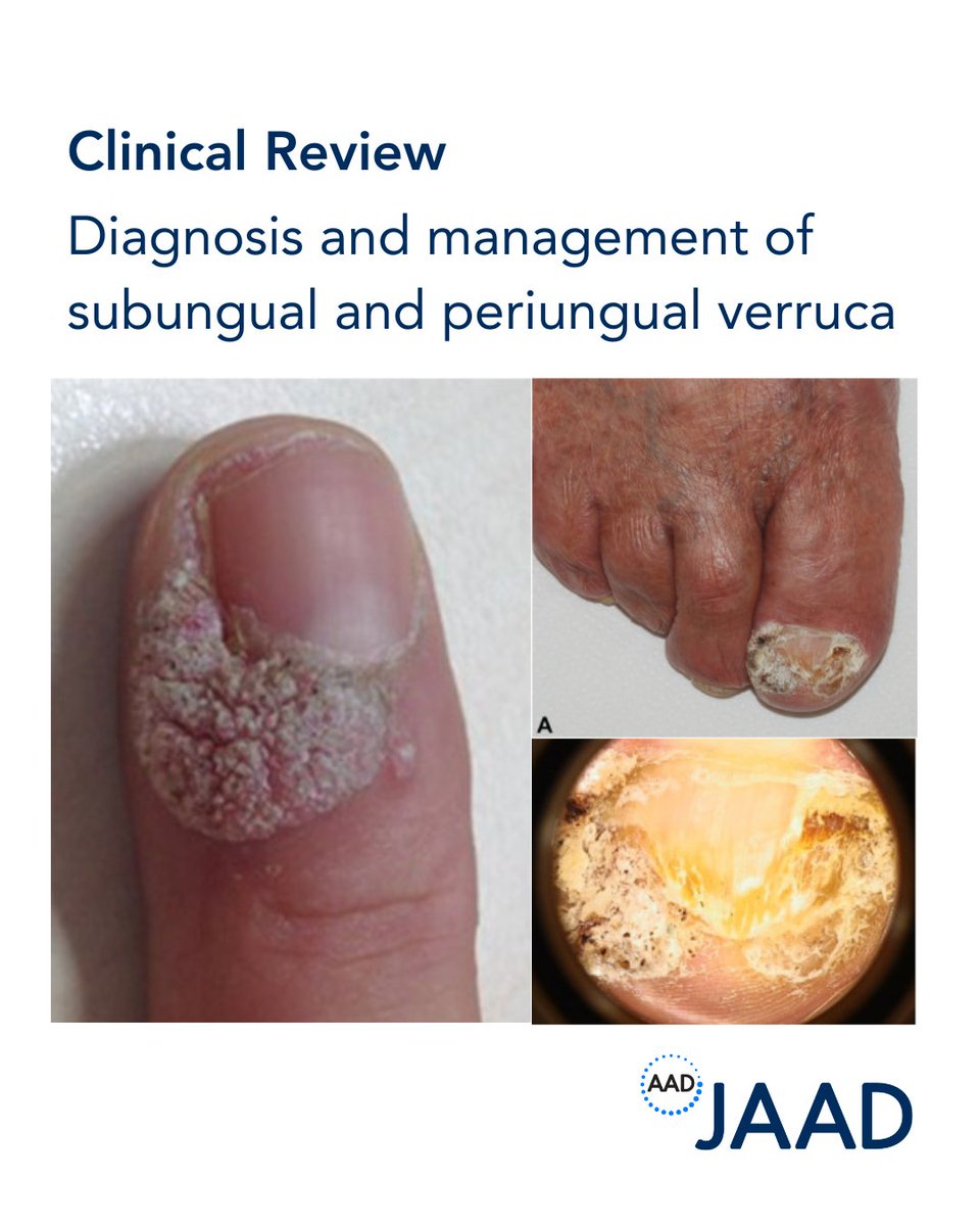 In this clinical review, authors dive into epidemiology, pathogenesis, clinical features, and treatments for nail unit verruca: bit.ly/4cI1MQo