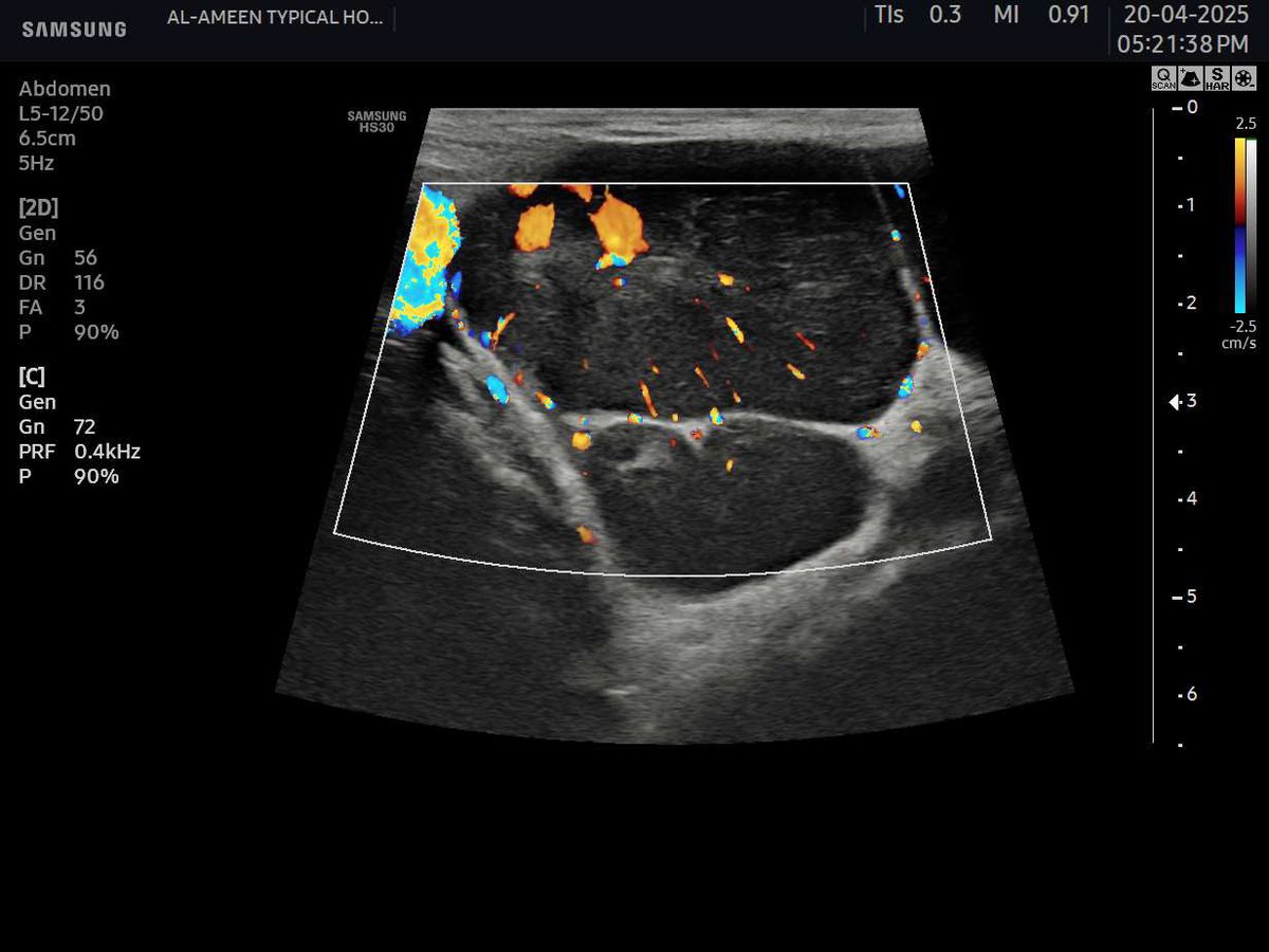 EchoTech_4's tweet photo. 54 years male patient presented with slow growing painless RT axillary palpable masses since 2 months.
No Fever , no cough.
Your diagnosis?
Recommendation?
#Echo_Tech https://t.co/oNI2IztExp