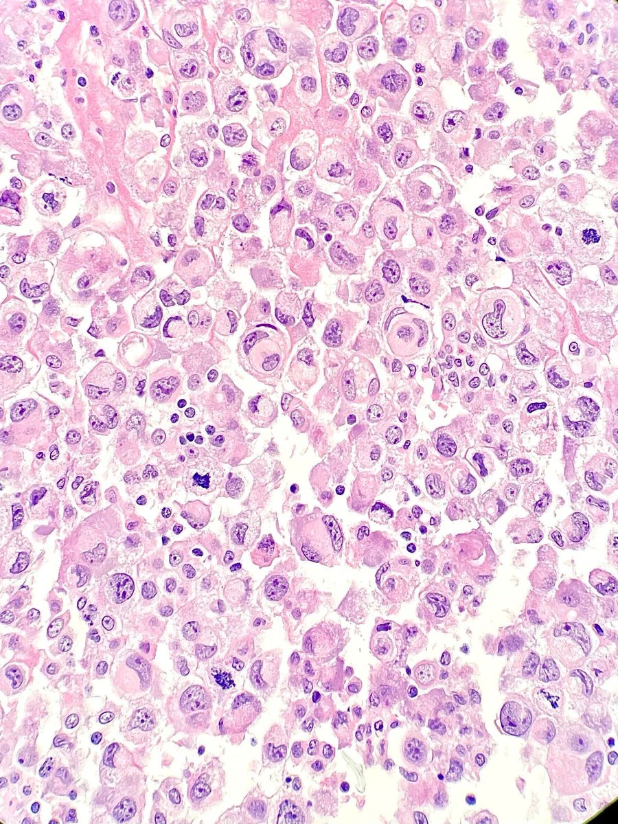 Ascites fluid containing metastatic cholangiocarcinoma. Tumor cells with signet ring morphology are seen. What cytologic preparation is seen here? Answer: buff.ly/FE5njaF #CytoPath #Cytopathology #PathArt #MedTwitter #PathTwitter