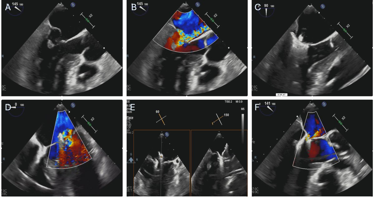 Twinkle xu (@twinkle_imr) on Twitter photo ⚡️New in <a href="/RCMjournal/">Reviews in Cardiovascular Medicine</a>
Can #MTEER reshape outcomes in acute ischemic mitral regurgitation?
A cutting-edge review by Dr. <a href="/FrazzettoMarco/">Marco Frazzetto</a> et al. explores evidence, challenges & future directions.
👉 Read more: imrpress.com/journal/RCM/26…
#CardioTwitter #MitralValve #StructuralHeart ⚡️New in <a href="/RCMjournal/">Reviews in Cardiovascular Medicine</a>
Can #MTEER reshape outcomes in acute ischemic mitral regurgitation?
A cutting-edge review by Dr. <a href="/FrazzettoMarco/">Marco Frazzetto</a> et al. explores evidence, challenges & future directions.
👉 Read more: imrpress.com/journal/RCM/26…
#CardioTwitter #MitralValve #StructuralHeart