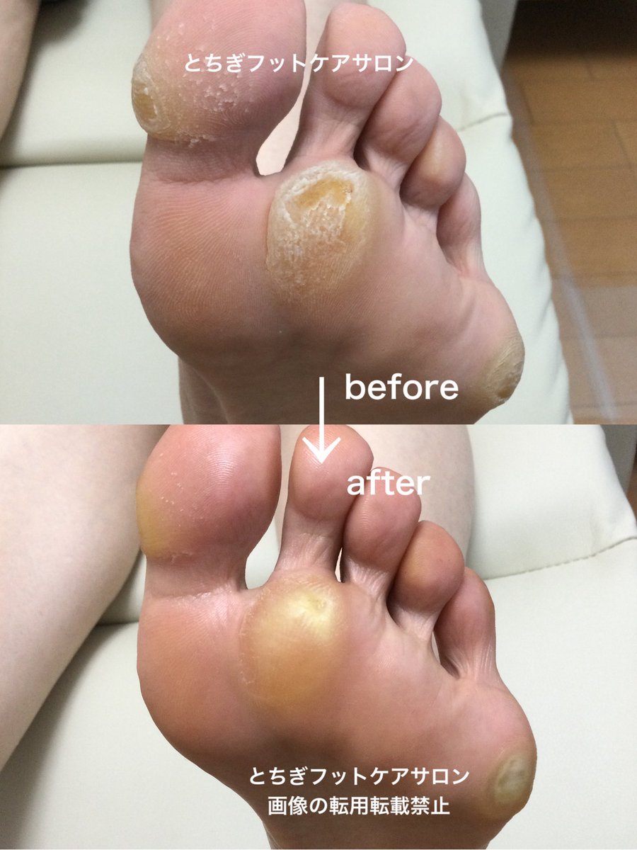 とちぎフットケアサロン-茂木有紀 (@fuss04tochigi) / Posts / X