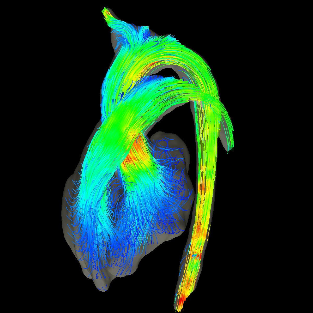 CFD_Inc's tweet photo. iTFlow®は、非造影位相コントラストCine MRIデータから、心臓や血管内の血流を2D・3Dで可視化・解析できるソフトウェアです。
製品の詳細や症例紹介は公式HPにてご紹介しています。
🫀https://t.co/xjxOj5tTFT
#血流解析 #心臓は血流で解析する時代へ #iTFlow #心臓MRI #心疾患 #先天性心疾患 https://t.co/bSN7QMAZfg