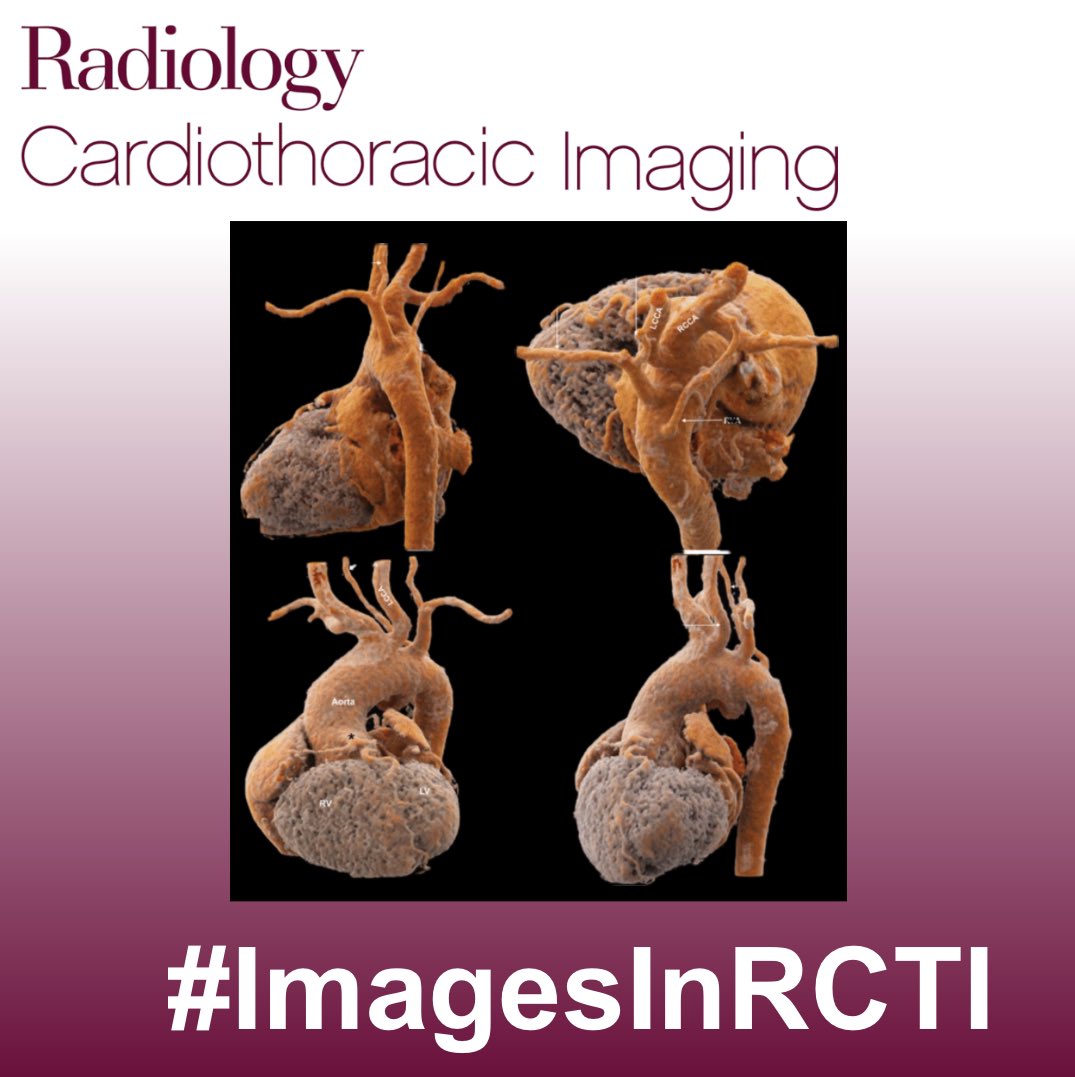 Roberta Catania (@robi_catania) on Twitter photo 🚨 Check the new case from Images in <a href="/RadiologyCTI/">Radiology: Cardiothoracic Imaging</a> 🚨
11-years-old girl with cyanosis.
What are the findings? What isthe diagnosis?
#InTrainingRCTI #ImagesInRCTI 🚨 Check the new case from Images in <a href="/RadiologyCTI/">Radiology: Cardiothoracic Imaging</a> 🚨
11-years-old girl with cyanosis.
What are the findings? What isthe diagnosis?
#InTrainingRCTI #ImagesInRCTI