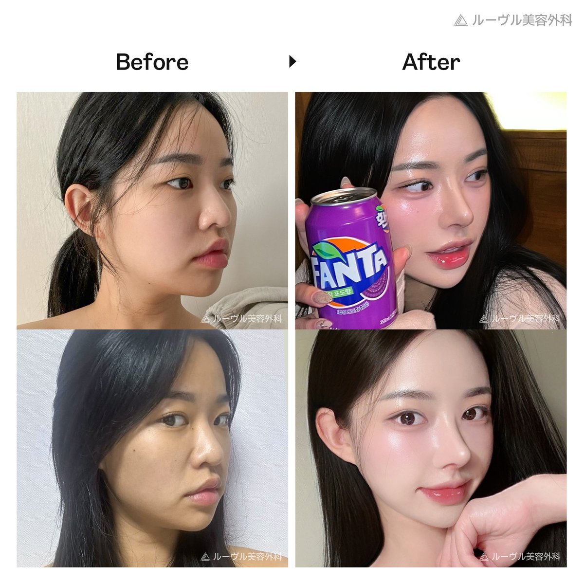 #鼻整形 は #ルーヴル美容外科 で1回で完璧に💯
団子鼻、ワシ鼻、初めての鼻整形、鼻修正、、
どんな鼻でもご希望通りの #オシャレ な鼻ラインに改善❣
#韓国整形  #韓国旅行 #ソウル #渡韓 #整形 #韓国美容 #美活 #美魔女 #美容マニア #江南 #kpop #鼻ぺちゃ🫶☎️line.me/ti/p/hEUSr12jKi
