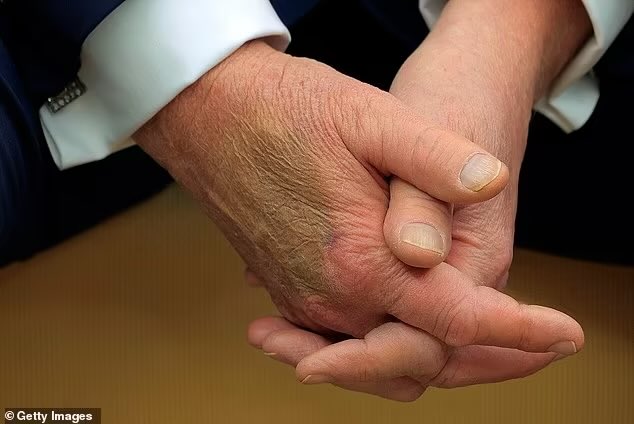 jadbrooks's tweet photo. @Agent06857942 @RonFilipkowski @Acyn Yeah, like what are they injecting into #FROTUS’s hand? (They keep trying to cover it with bad makeup) 🤷🏻♀️ https://t.co/NfaHzQxwdw