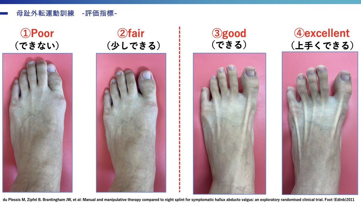 oshiroakito's tweet photo. 外反母趾の運動療法🦶

様々な要因が関与する病態。

靴やインソール、後足部アライメント
姿勢制御など、原因への介入が必須。

ただ、
結果因子だとしても足趾自体の
変形にも着目する必要があります。

数少ないエビデンスがある介入だし
足趾機能障害は2次障害へ発展します🦶

#原因は追求するよ https://t.co/aTSne3VXxN