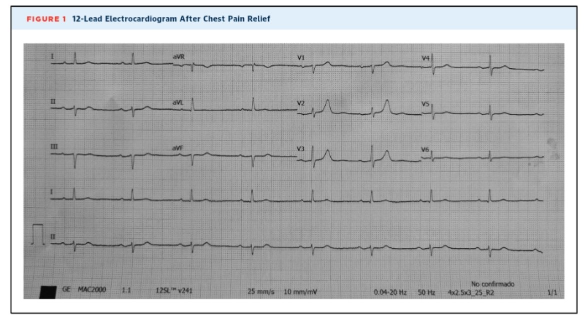 What Are These Anterior T Waves?: A High-Risk Ischemic Pattern That Should Be Recognized | JACC: Case Reports jacc.org/doi/10.1016/j.…