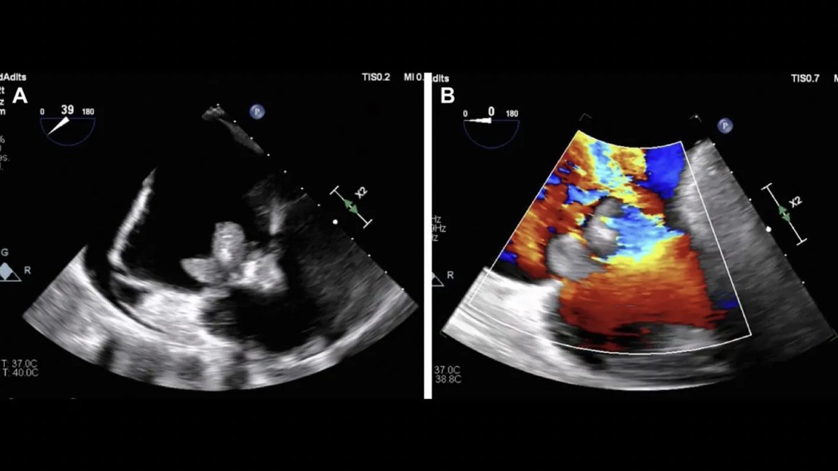 Fundación FIC (@fundacion_fic) on Twitter photo #Endocarditis tras reparación tricuspídea percutánea, un raro caso poco documentado en la literatura científica.
📄<a href="/JACCJournals/">JACC Journals</a>
👨⚕️<a href="/JcGomezpolo/">Juan Carlos Gomez Polo</a>
fundacionfic.es/endocarditis-t… #Endocarditis tras reparación tricuspídea percutánea, un raro caso poco documentado en la literatura científica.
📄<a href="/JACCJournals/">JACC Journals</a>
👨⚕️<a href="/JcGomezpolo/">Juan Carlos Gomez Polo</a>
fundacionfic.es/endocarditis-t…
