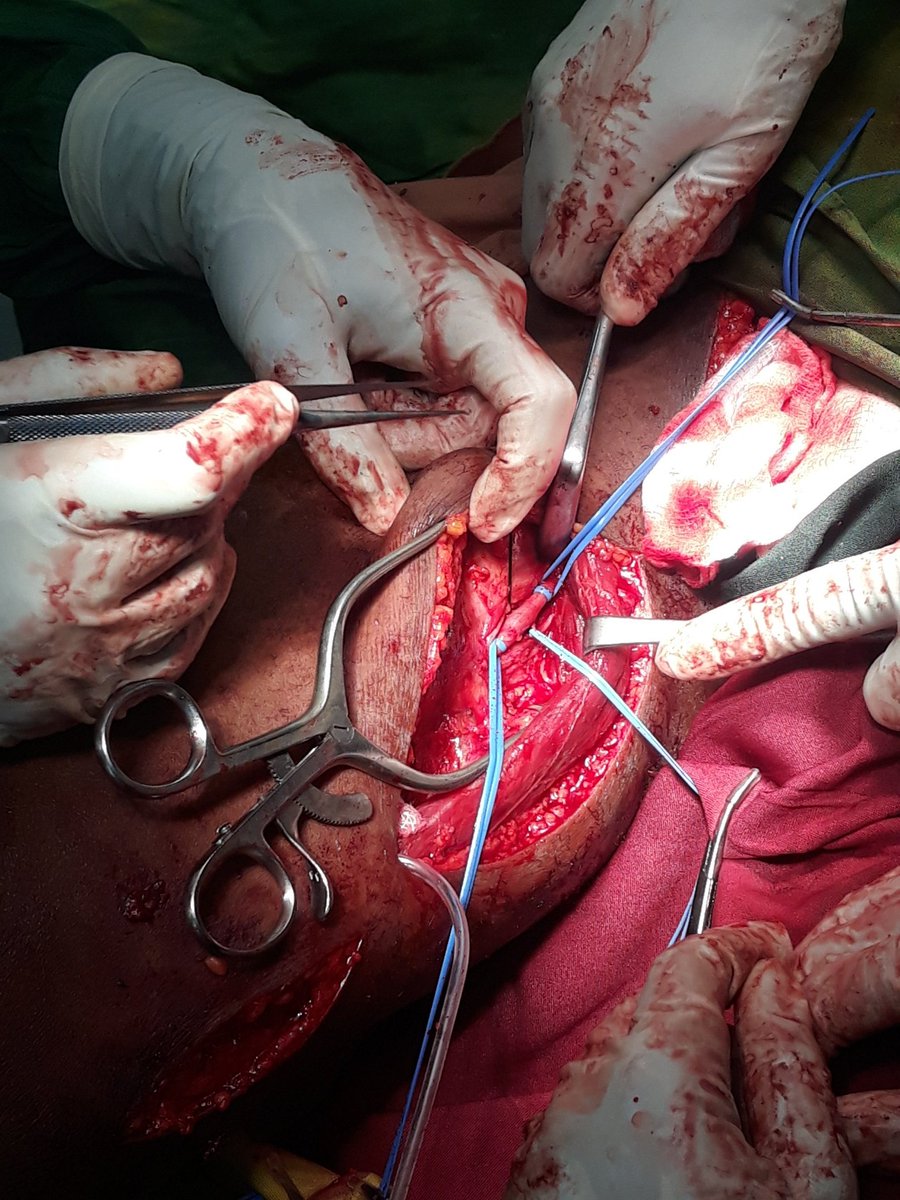 Rugasire Christian MD (@rugasirechris) on Twitter photo the first time observing superficial femoral artery to popliteal artery bypass , using the great saphenous vein on the ipsilateral leg as a graft. The diagnosis of the patient was chronic limb threatening ischemia rutherford category 5. <a href="/AmCollSurgeons/">American College of Surgeons</a> <a href="/JVS_VascSci/">JVS-Vascular Science</a> the first time observing superficial femoral artery to popliteal artery bypass , using the great saphenous vein on the ipsilateral leg as a graft. The diagnosis of the patient was chronic limb threatening ischemia rutherford category 5. <a href="/AmCollSurgeons/">American College of Surgeons</a> <a href="/JVS_VascSci/">JVS-Vascular Science</a>