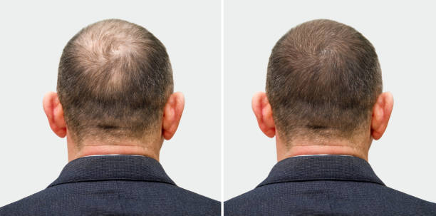 Culture_Desk_'s tweet photo. Your thinning hair because of "aging" - it's a NUTRIENT DEFICIENCY that's completely fixable.

The $13.9 billion hair care industry sells shampoos when the real solution is ON your plate.

Here's what they don't want you to know: 🧵 https://t.co/yWgTAjuGAQ