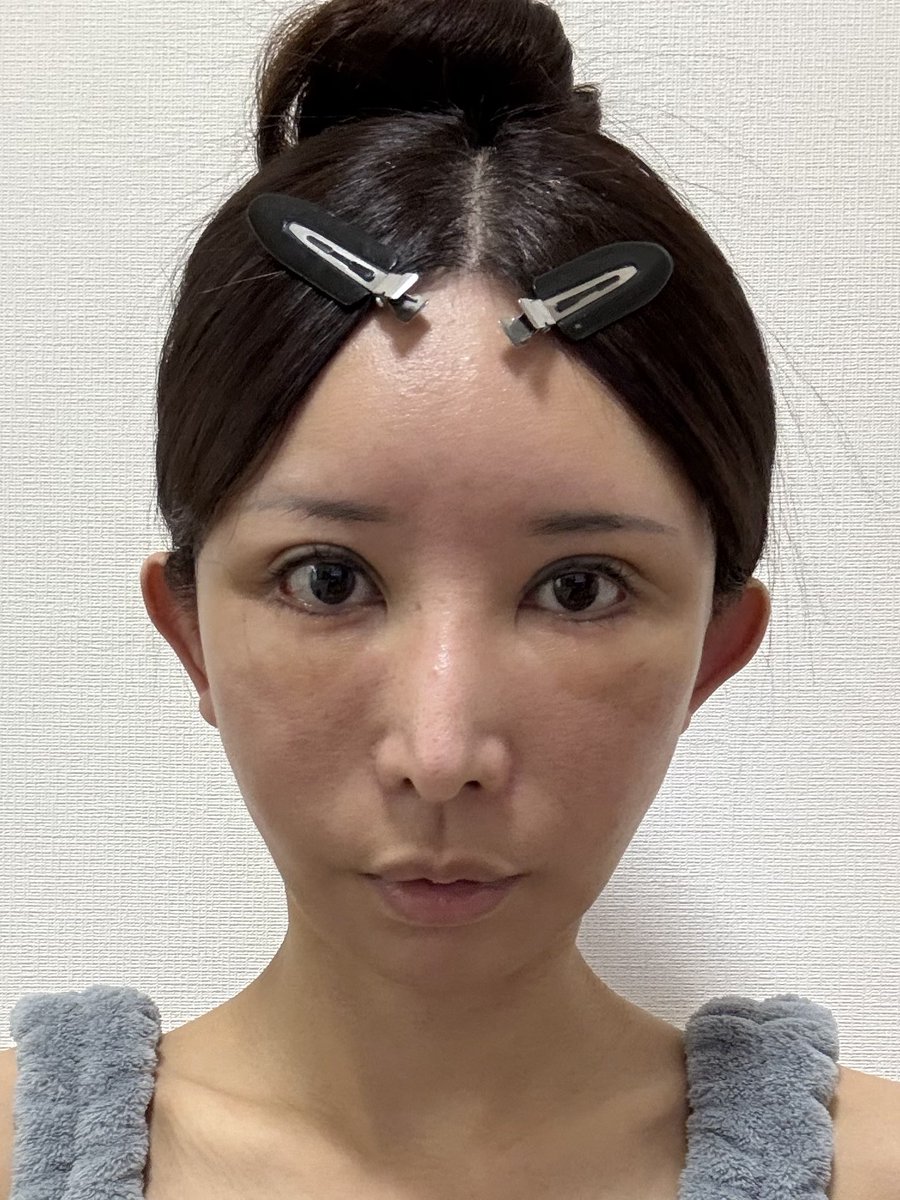 an20230422's tweet photo. 【術後2週間目】
���れは少しずつ落ち着いてきてます♪

眼輪筋の切除で左目、左眉毛が未だに動きにくいですが、今後は目の周りのシワに悩まされないと思うと楽しみです(⁎⁍̴̛ᴗ⁍̴̛⁎)顔の感覚は口周りから戻ってきている感じです。

#セミン整形外科 #整形垢 #韓国整形 
#切開リフト #フェイスリフト https://t.co/saJNx1tt7y