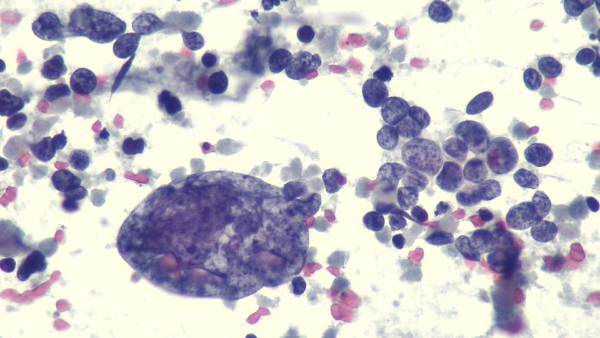 Lola Lozano (@mdlozanoe) on Twitter photo 🔊📢Remember: small cell carcinoma of the lung has some “not so small” cells.
This is much more appreciated in cytologic specimens 🔬🫁👌 <a href="/EfcsYoung/">Young EFCS</a> <a href="/SECitologia/">Sociedad Española de Citología</a> <a href="/IACytology/">International Academy Cytology</a> <a href="/cytopathology/">Cytopathology.org</a> <a href="/mtsiddi/">Momin Siddiqui</a> <a href="/gcai1978/">Guoping Cai, MD</a> <a href="/DrZulueta/">Dr. Javier Zulueta</a> <a href="/MauroSaieg/">Mauro Saieg, MD, PhD, FIAC</a> <a href="/Sara_Jiang/">Xiaoyin "Sara" Jiang, MD (She/Her)</a> <a href="/MansoAso/">Sonsoles Aso Manso</a> <a href="/SEAP_IAP/">SEAP-IAP</a> 🔊📢Remember: small cell carcinoma of the lung has some “not so small” cells.
This is much more appreciated in cytologic specimens 🔬🫁👌 <a href="/EfcsYoung/">Young EFCS</a> <a href="/SECitologia/">Sociedad Española de Citología</a> <a href="/IACytology/">International Academy Cytology</a> <a href="/cytopathology/">Cytopathology.org</a> <a href="/mtsiddi/">Momin Siddiqui</a> <a href="/gcai1978/">Guoping Cai, MD</a> <a href="/DrZulueta/">Dr. Javier Zulueta</a> <a href="/MauroSaieg/">Mauro Saieg, MD, PhD, FIAC</a> <a href="/Sara_Jiang/">Xiaoyin "Sara" Jiang, MD (She/Her)</a> <a href="/MansoAso/">Sonsoles Aso Manso</a> <a href="/SEAP_IAP/">SEAP-IAP</a>