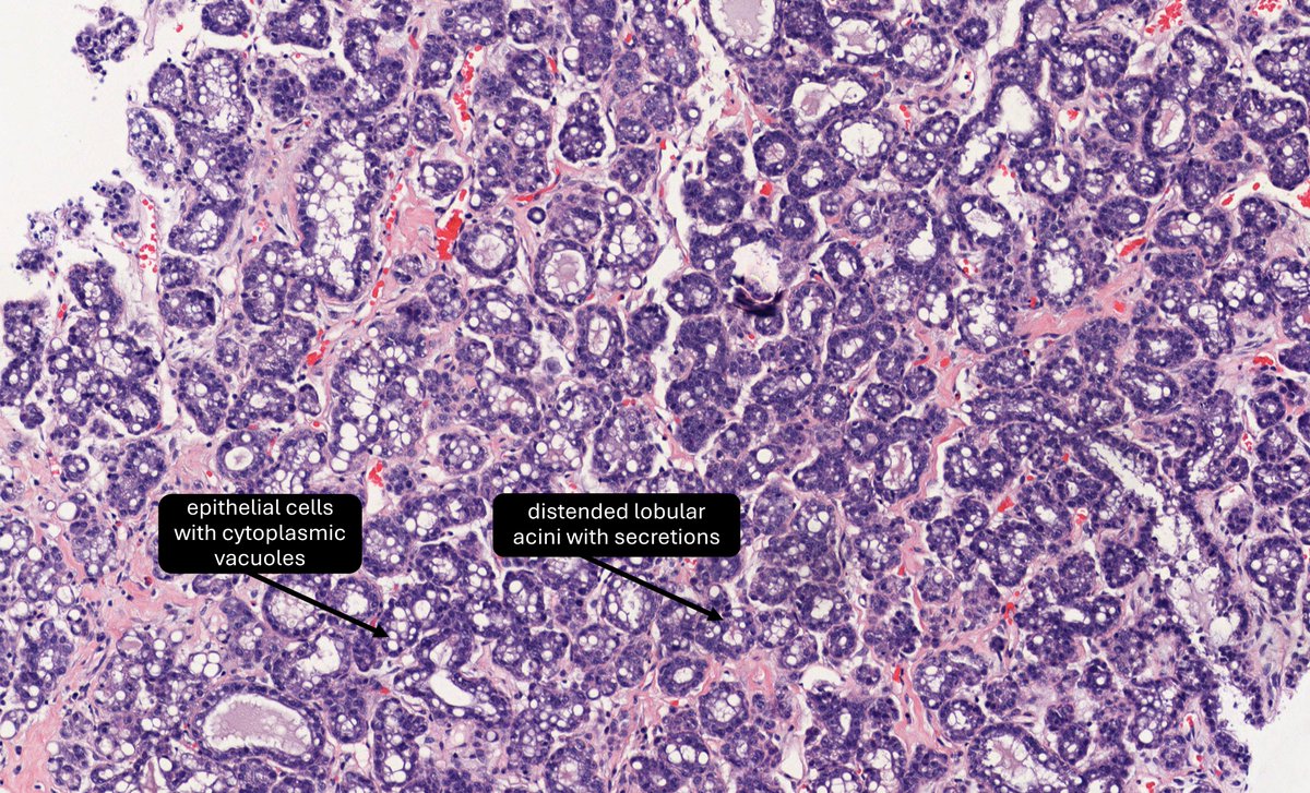 DrCycloPath's tweet image. ❌Lactating Adenoma
Proliferation of glands showing secretory/lactational change
Lacks granulomas/significant inflammation unless ruptured.
#BreastPath #IDPath #Pathology #PathTwitter