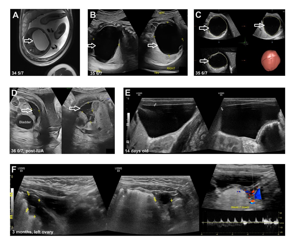 Large fetal ovarian cyst (8x7x7cm) managed with prenatal US-guided aspiration. Clinical decisions balanced maternal wishes &amp; fetal safety.

Read our case report and literature review here: thieme-connect.de/products/ejour…

#fetalintervention #fetalcyst #MFM #ObGyn #prenatalcare