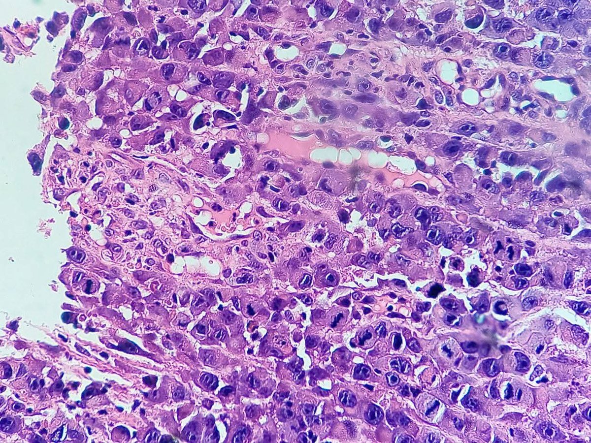 pathphyo's tweet photo. 80 years old man with ulcerated lesion on hard palate. H&amp;E sections reveal infiltrating pleomorphic tumor cells with rhabdoid morphology and sarcomatous appearanc.IHC came out positive staining for Pan CK, CK 5/6, p40, INI 1 and negative staining for desmin, myogenin and S 100. https://t.co/ZeETGeADcF