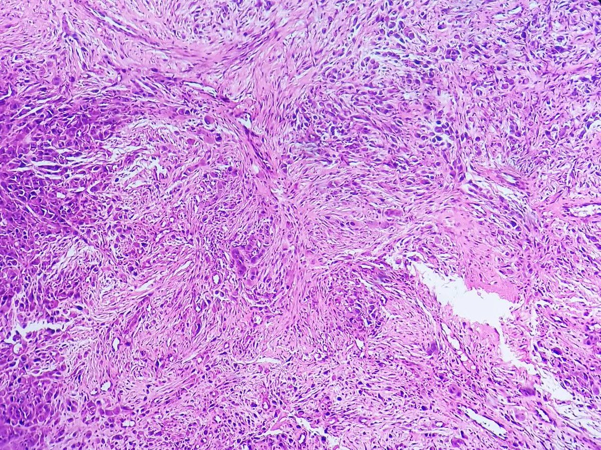 pathphyo's tweet photo. 80 years old man with ulcerated lesion on hard palate. H&amp;E sections reveal infiltrating pleomorphic tumor cells with rhabdoid morphology and sarcomatous appearanc.IHC came out positive staining for Pan CK, CK 5/6, p40, INI 1 and negative staining for desmin, myogenin and S 100. https://t.co/ZeETGeADcF
