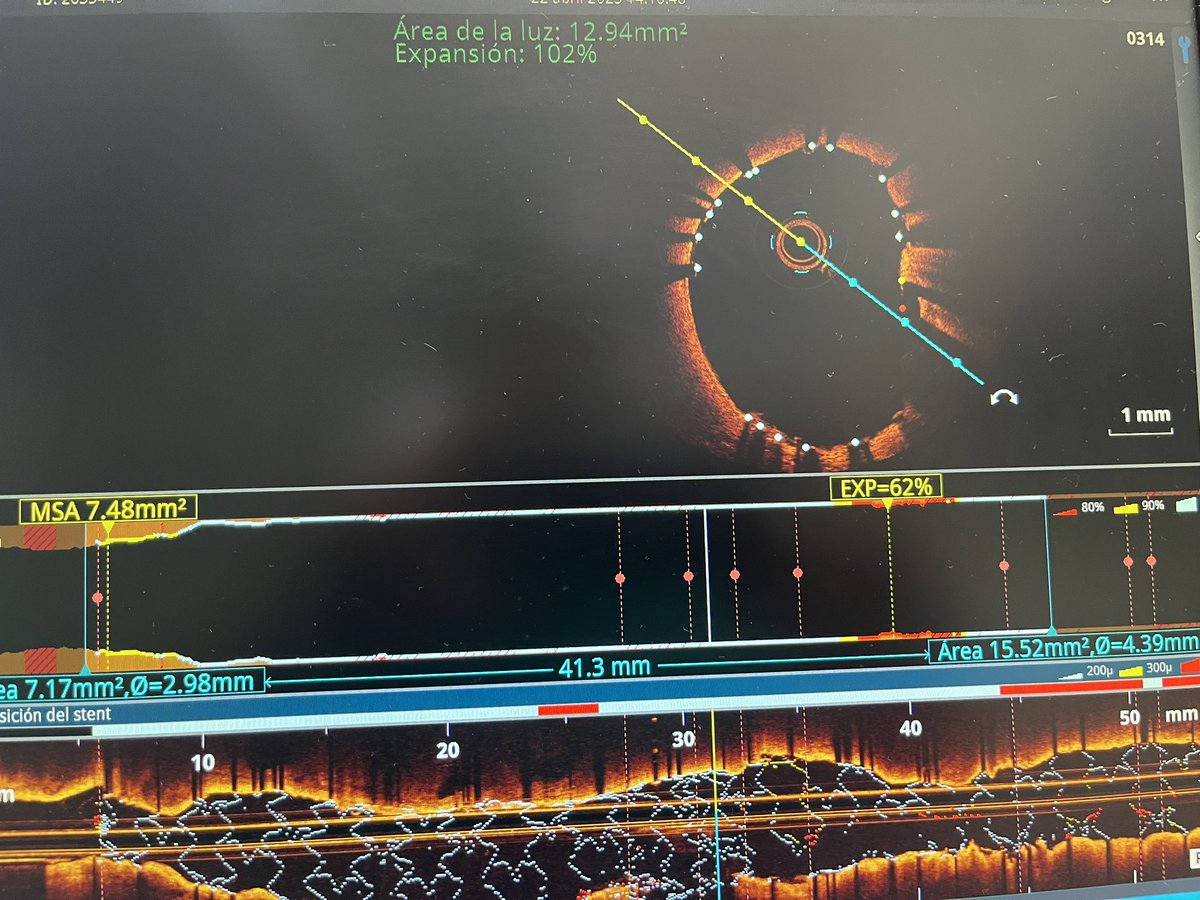 Ricardo Mori (@rmori11) on Twitter photo 1er caso aleatorizado a Orbit-Shock trial <a href="/ASanchezRecalde/">Angel Schez-Recalde</a> @JeremiasBayonLorenzo <a href="/carlosjuanatey/">carlosjuanatey</a> 1er caso aleatorizado a Orbit-Shock trial <a href="/ASanchezRecalde/">Angel Schez-Recalde</a> @JeremiasBayonLorenzo <a href="/carlosjuanatey/">carlosjuanatey</a>