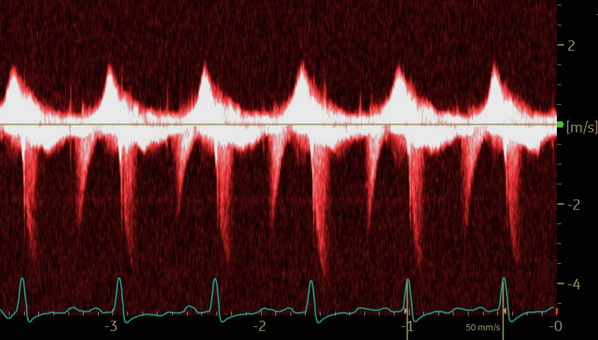 A patient with shortness of breath. A CW Doppler interrogation across the mitral valve is shown. 1/2