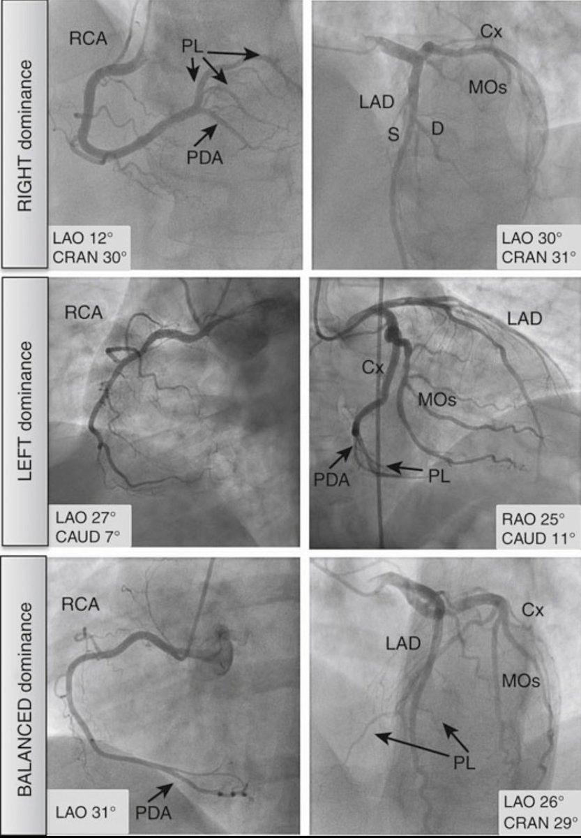 Coronary Artery Dominance: A Key Concept in Angiography

Dominance is defined by which artery gives rise to the posterior descending artery (PDA):
• Right dominance – PDA from RCA
• Left dominance – PDA from LCx
• Balanced – PDA from both RCA &amp; LCx

Prevalence:
• Right