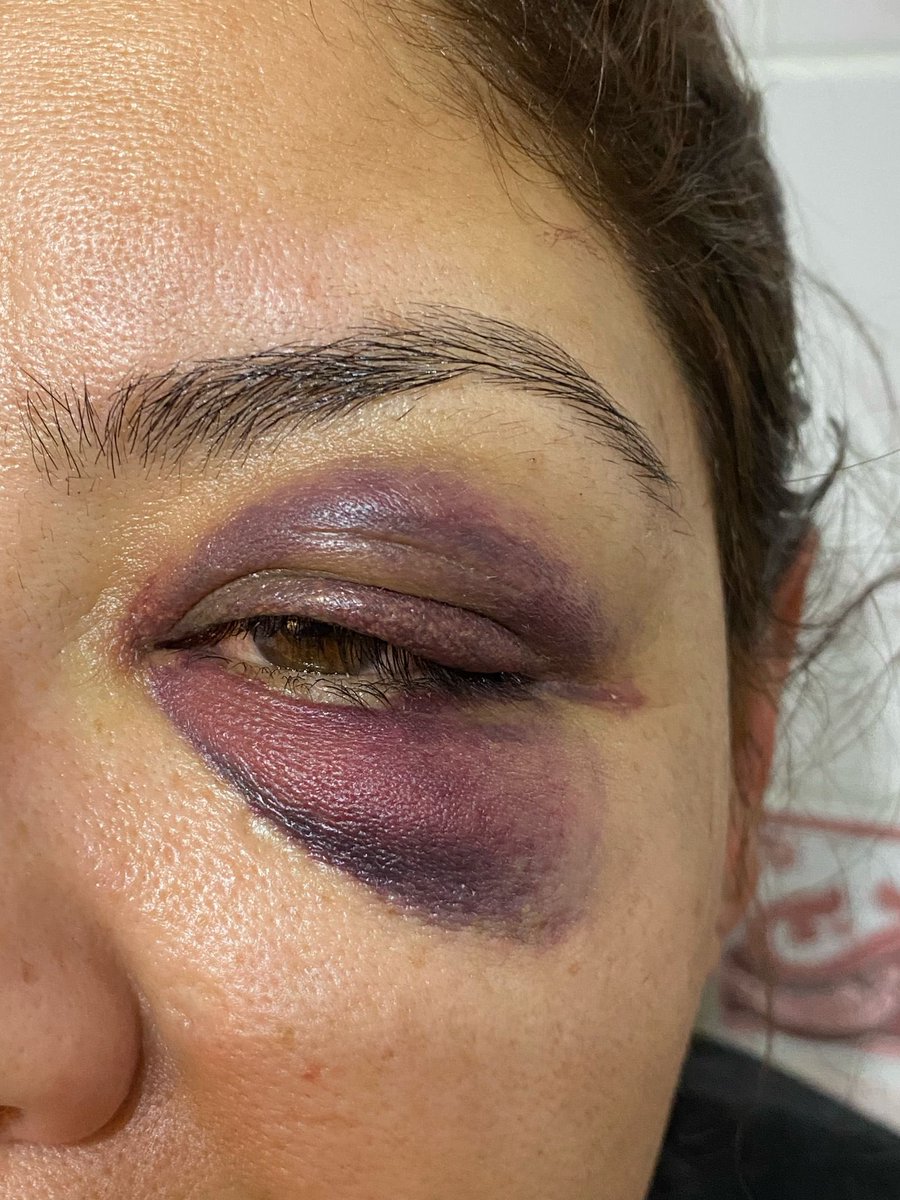 SEMRA ABLA EŞİ TARAFINDAN fiziksel ve psikolojik şiddete maruz kalıyor.
Şikayet etmiş olsa da eşinin ölüm tehditleri yüzünden geri çevirmek zorunda kaldı. 
Kendisini ve kızını öldürecegini söylüyor çok geç onların sesleri olalım.
#SemrayaSesol