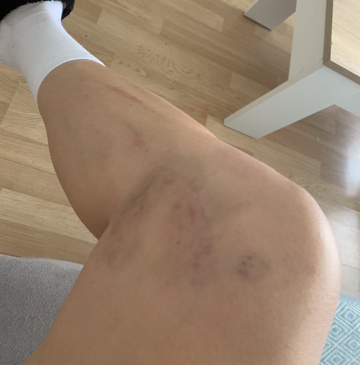 Des del sábado con un dolor increíble. Y esto solo ha supuesto un partido de sanción. Increíble que la sanción de Mapi por “dirigirse de manera inapropiada” : 2 partidos. <a href="/maripaz_vilas/">Mari Paz Vilas</a> <a href="/PIOFCFemenil/">PIO FC Femenil</a>