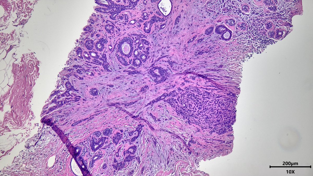 Radial scar 🌟Stellate architecture with central fibroelastotic center and radiating ducts and lobules (with or without other proliferative changes like UDH) #breastpath #pathx #PathTwitter #pathresidents #pathology