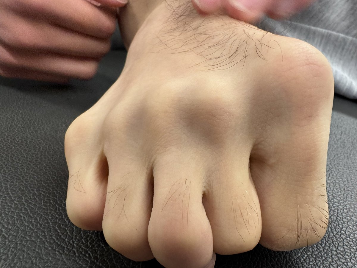 ¿Mano o pie?  😜

<a href="/PasionAnatomia/">Pasión por la Anatomía</a> <a href="/raiguade/">Ramon Aiguadé</a>