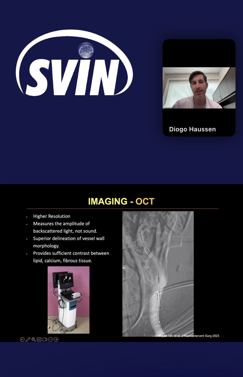 Sitara Koneru, MD (@sitarakoneru) on Twitter photo Great <a href="/svinsociety/">SVIN</a> Grand Rounds by <a href="/DiogoHaussen/">Diogo Haussen</a> on one of my favorite entities #CaW <a href="/EmoryStroke/">Emory & Grady Vascular Neurology</a> <a href="/StrokeAHA_ASA/">Stroke AHA/ASA</a> <a href="/YoungNIR/">YoungNIR</a> Great <a href="/svinsociety/">SVIN</a> Grand Rounds by <a href="/DiogoHaussen/">Diogo Haussen</a> on one of my favorite entities #CaW <a href="/EmoryStroke/">Emory & Grady Vascular Neurology</a> <a href="/StrokeAHA_ASA/">Stroke AHA/ASA</a> <a href="/YoungNIR/">YoungNIR</a>