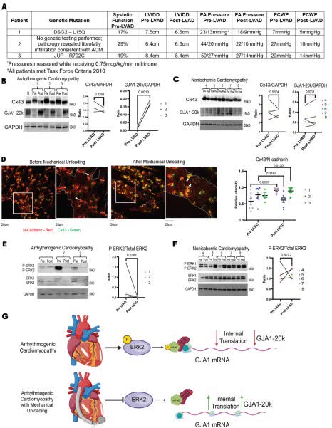 Circ: Heart Failure (@circhf) on Twitter photo LVAD unloading augments GJA1-20k expression in patients with arrhythmogenic cardiomyopathy, but not in patients with NICM. <a href="/NEH_CVRTI/">UofU Nora Eccles Harrison CVRTI</a> @palatinuslab #AHAJournals ahajrnls.org/4lDqh5r LVAD unloading augments GJA1-20k expression in patients with arrhythmogenic cardiomyopathy, but not in patients with NICM. <a href="/NEH_CVRTI/">UofU Nora Eccles Harrison CVRTI</a> @palatinuslab #AHAJournals ahajrnls.org/4lDqh5r