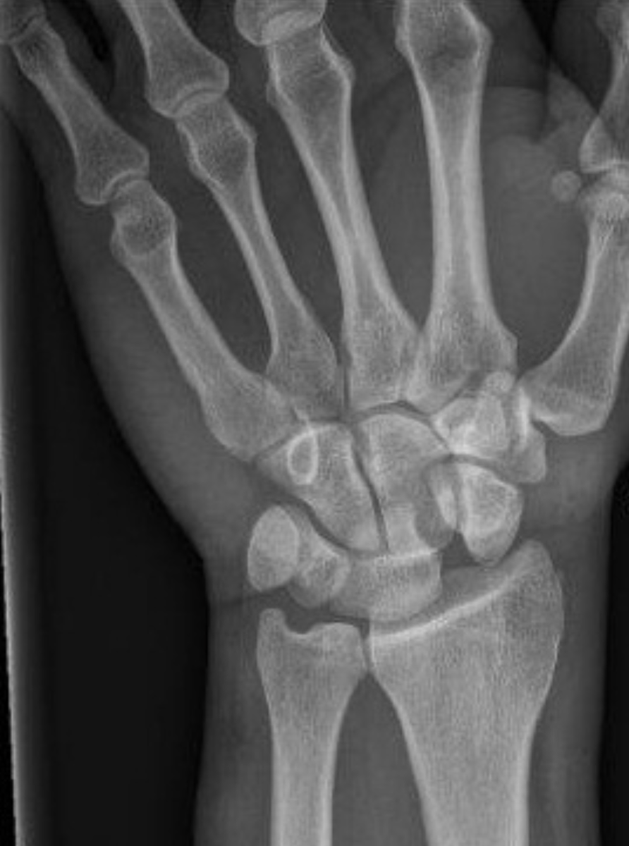 Shingo_Omata's tweet photo. <What’s your diagnosis?>
Pt: 35M
CC: Fall onto an outstretched hand
#Rdiag #RadEd #MedEd #MSKrad #ERrad #FOAMrad #FOAMed https://t.co/w8YTB4wqYZ