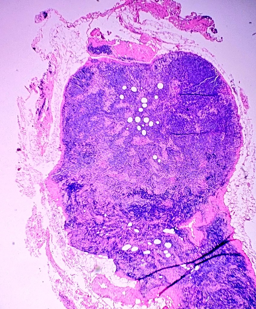 First tweet since forever.
Of an interesting profile seen in a lymph node!

Also to announce my departure from BIDMC as I'm off to my next adventure. I will miss everyone here in Boston endlessly. Stay happy and healthy everyone!

M.