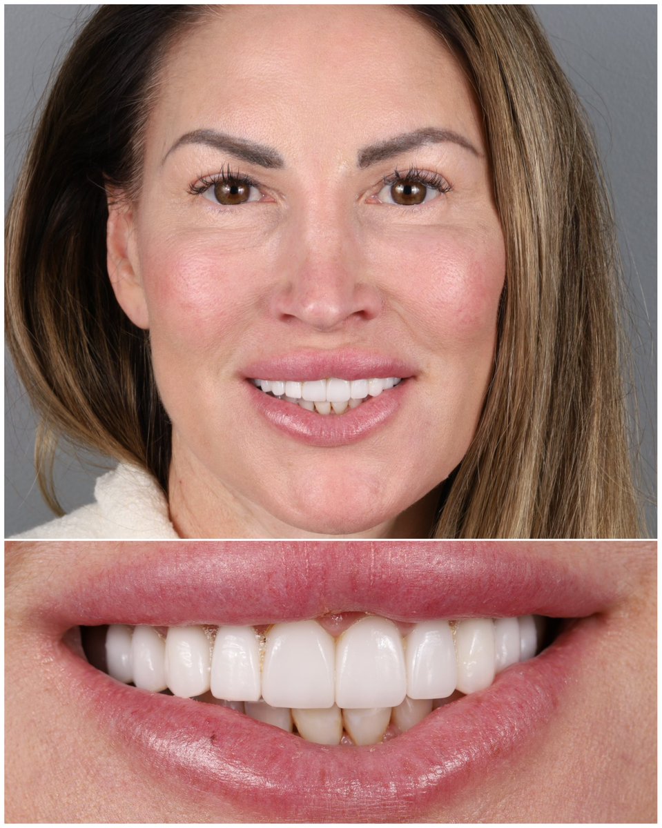 Swipe to see BEFORE ➡️
Patient’s goals: Pt didn’t like her original veneers (from a previous Dr) which were too big and bulky. She wanted her veneers to look more natural with better shape, color, and translucency
What did we do? 20 upper and lower porcelain Harmony veneers