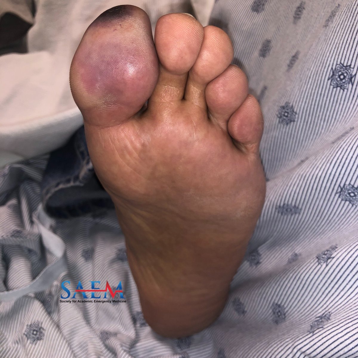SAEM Clinical Images Series: Painful Great Toe

What are you focusing on for the rest of your exam? What does this look like?

aliem.com/saem-clinical-…

<a href="/SAEMonline/">SAEM</a>