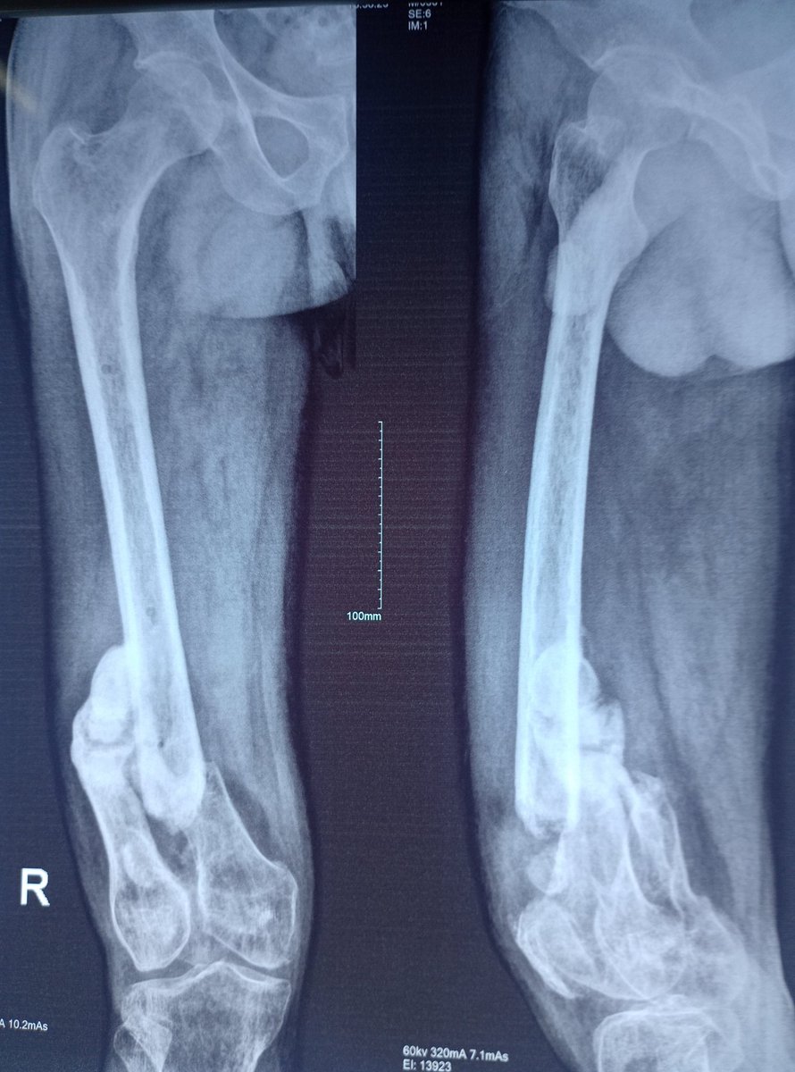 Fractures are better managed with better outcomes when treated within a few hours after injury.
