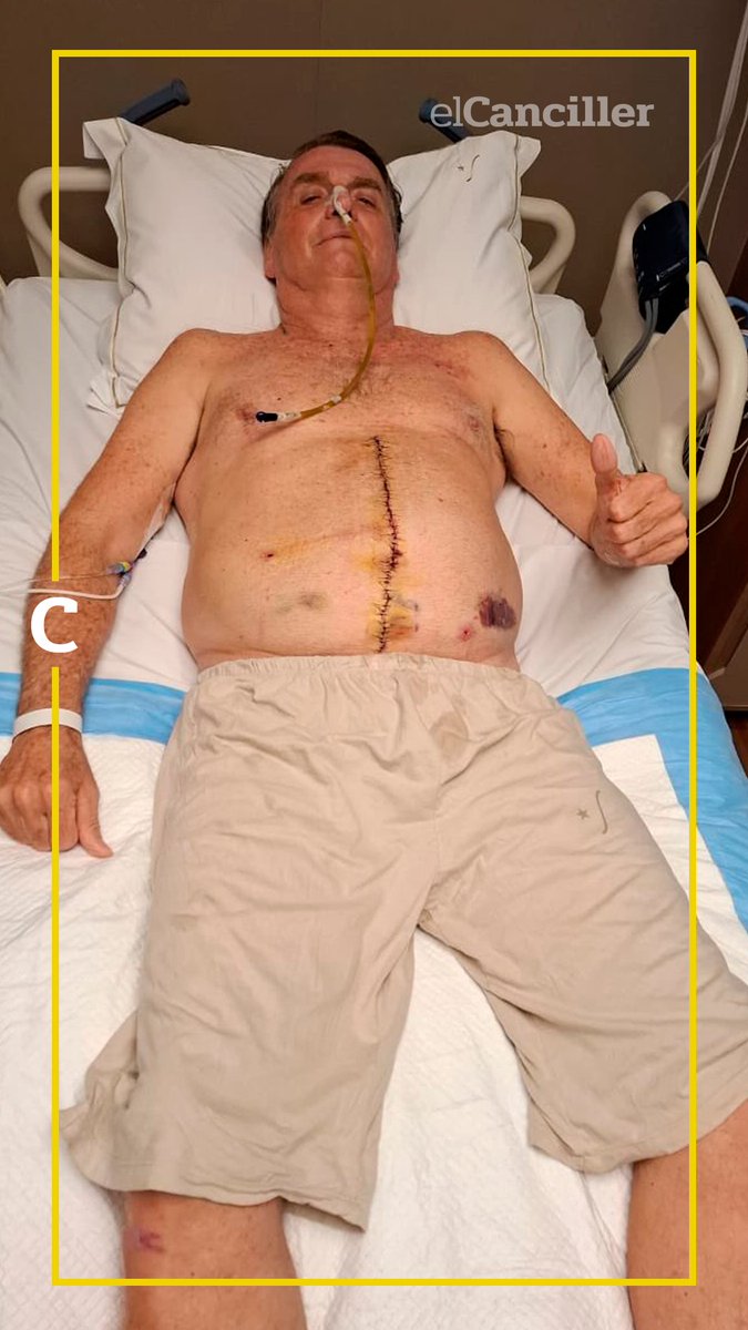 elcancillercom's tweet photo. [AHORA] "Sigo con fe, determinación y mucho agradecimiento": Bolsonaro tuvo "los primeros signos efectivos de movimiento instestinal", a una semana de la última cirugía. https://t.co/0hybHnrZYg