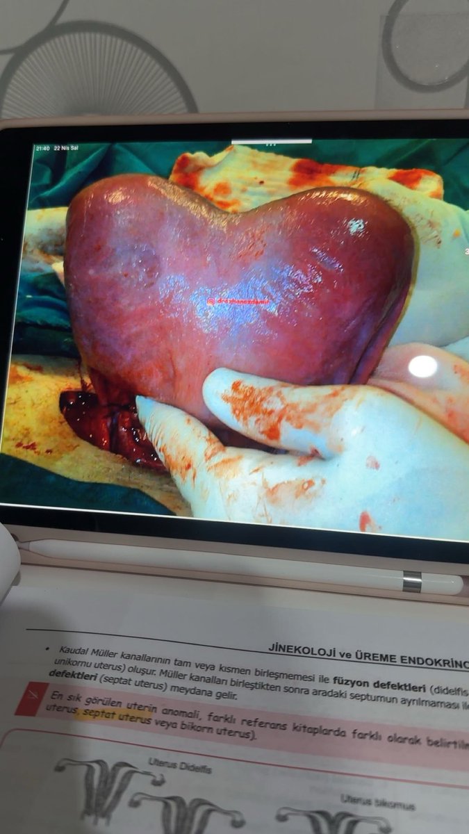 kalp şeklinde uterus beğenen sezaryen doğuma hak kazanıyoo