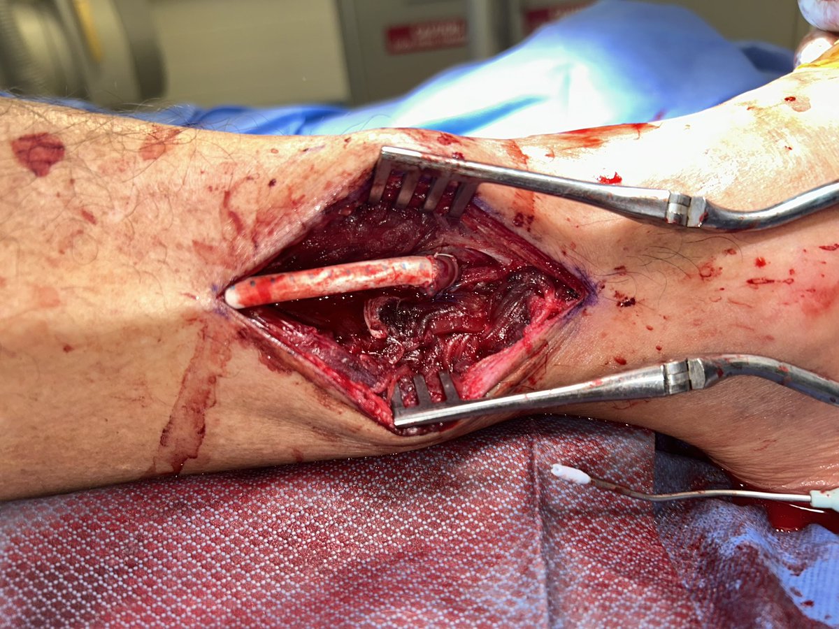 Partial fibula resection for CFA to distal peroneal bypass with 6mm ringed Propaten and Miller cuff. An essential technique in the #vascularsurgery toolbox for #CLTI #limbpreservation !