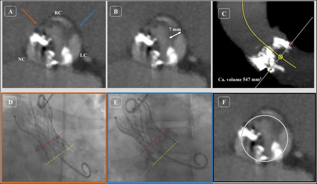 REC Publications (@revespcardiol) on Twitter photo Transcatheter aortic valve implantation in bicuspid aortic valves: present and future #REC #Aheadofprint <a href="/AlbertoAlperi/">Alberto Alperi</a> <a href="/paulantun/">Paula Antuña</a> <a href="/rutalvar3z/">Rut Álvarez Velasco</a> <a href="/PabloAvanzas/">Pablo Avanzas</a> revespcardiol.org/en-transcathet… Transcatheter aortic valve implantation in bicuspid aortic valves: present and future #REC #Aheadofprint <a href="/AlbertoAlperi/">Alberto Alperi</a> <a href="/paulantun/">Paula Antuña</a> <a href="/rutalvar3z/">Rut Álvarez Velasco</a> <a href="/PabloAvanzas/">Pablo Avanzas</a> revespcardiol.org/en-transcathet…