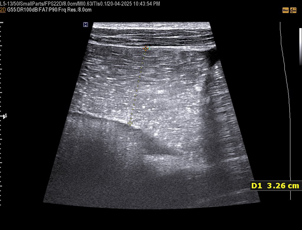EchoTech_4's tweet photo. 30 years male with a history of Rectal Ca underwent surgery and Chemotherapy since 2 months , now he presents with painful Abdominal distension, Absolute constipation and repeated vomiting.
Diagnosis?
Management?
#Echo_Tech https://t.co/jhglmZ80as