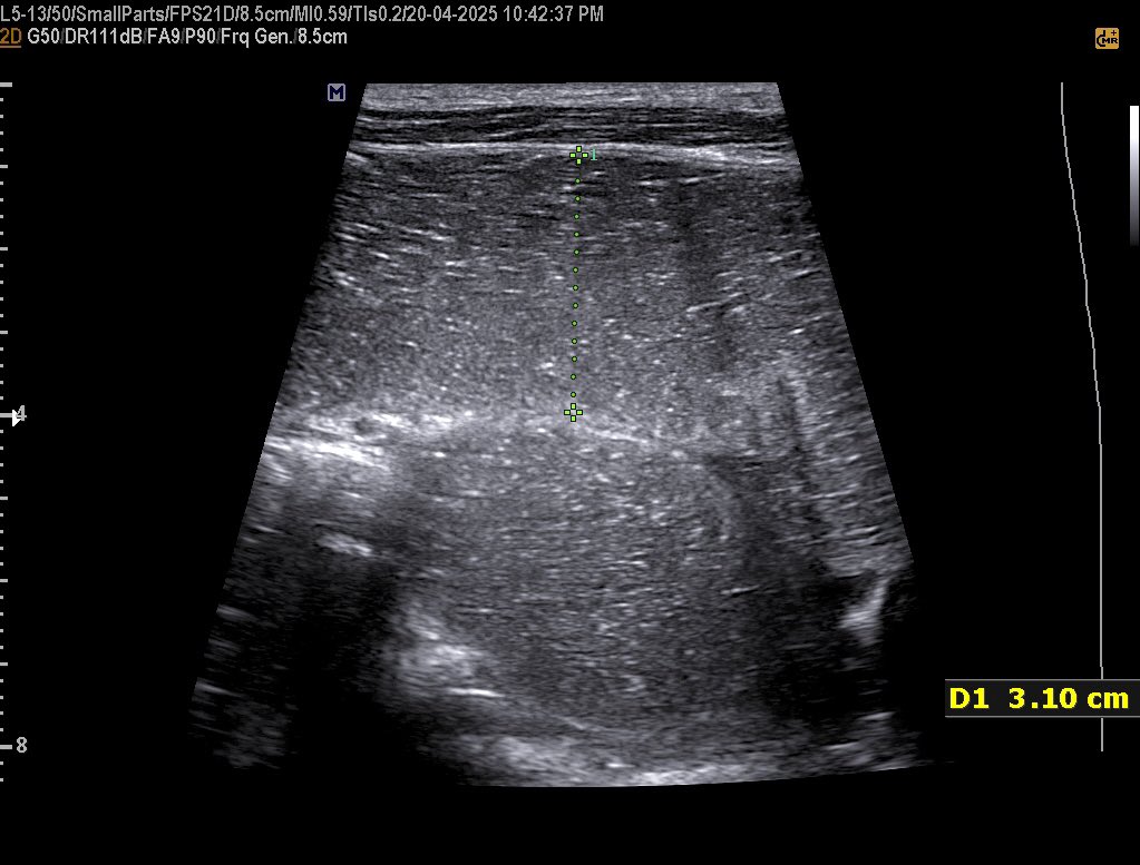EchoTech_4's tweet photo. 30 years male with a history of Rectal Ca underwent surgery and Chemotherapy since 2 months , now he presents with painful Abdominal distension, Absolute constipation and repeated vomiting.
Diagnosis?
Management?
#Echo_Tech https://t.co/jhglmZ80as